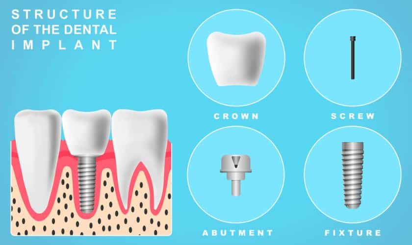 Featured image for “The Ultimate Guide To Dental Implants: Everything You Need To Know”