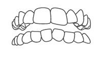 Illustration of upper and lower teeth alignment showing dental bite and orthodontic positioning.