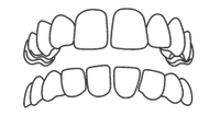Dental illustration showing upper and lower teeth alignment and bite relationship.