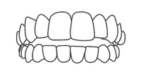 Dental illustration showing upper and lower teeth alignment and bite structure for orthodontic reference.