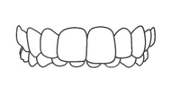 Dental alignment illustration showing upper teeth in orthodontic braces alignment diagram.