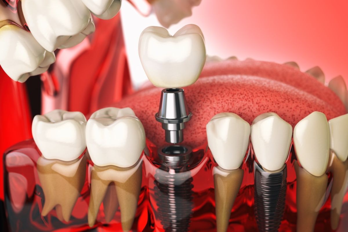 Featured image for “What Can Dental Implants in Albuquerque Do for Your Oral Health and Jaw Vitality?”