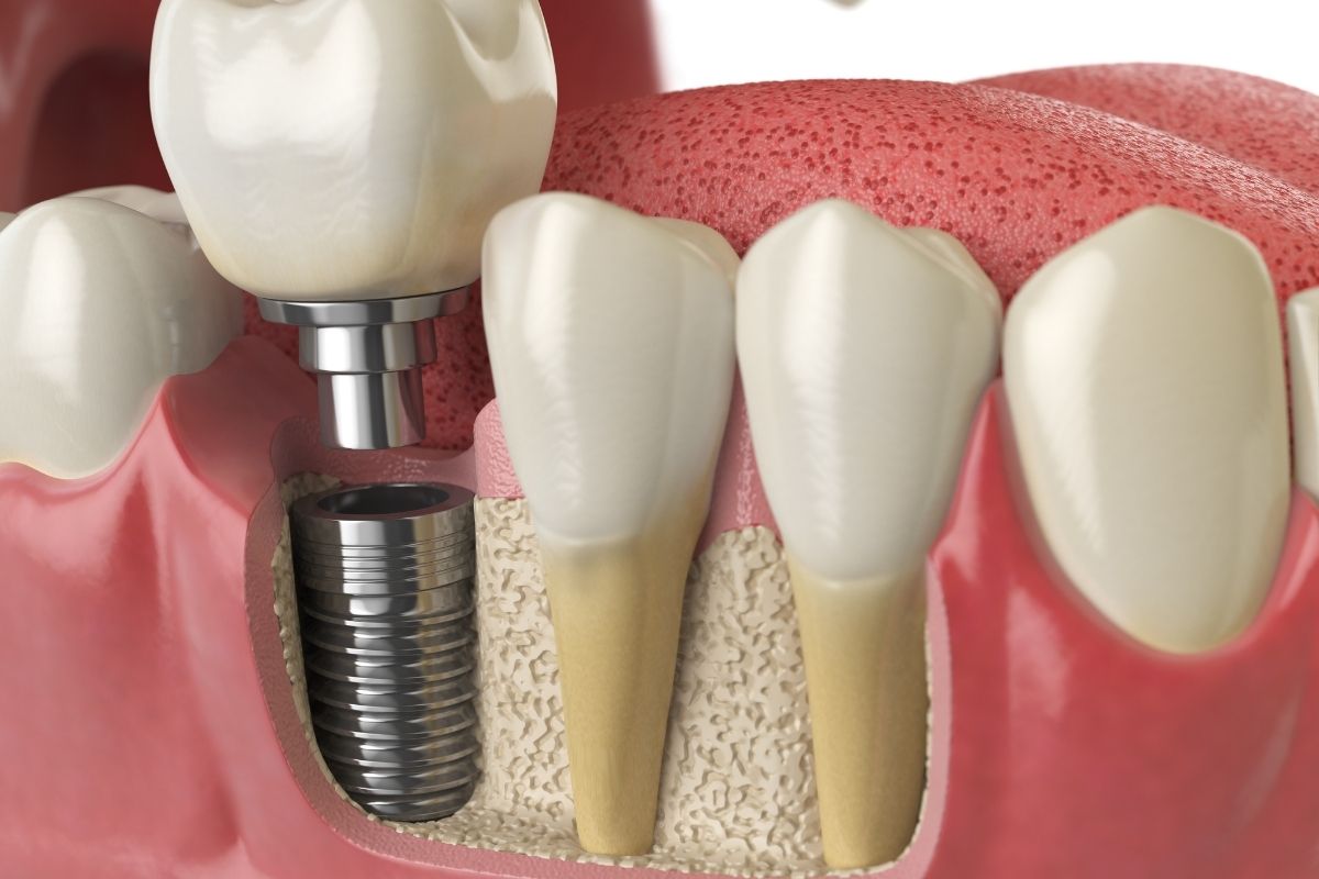 Featured image for “Why Early Evaluation During Your Dental Implant Consultation in Albuquerque Ensures Better Results”